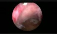 Hysteroscopic Morcellation of Submucous Myeoma
