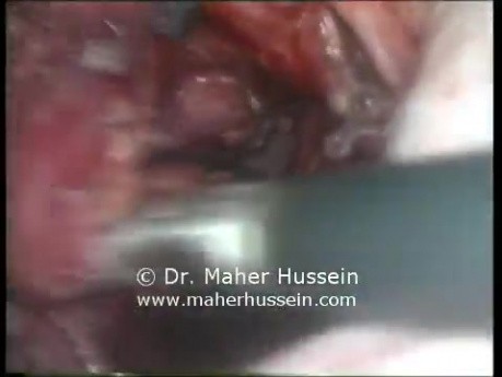 Pararectal tumor Excision - Laparoscopic Approach