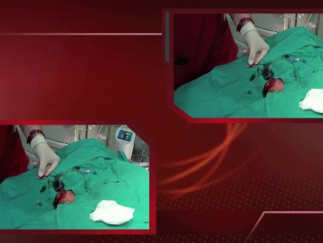 Jugular Catheter Insertion