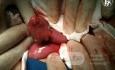 Meckel's Diverticulum