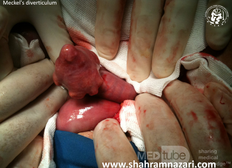 Meckel's Diverticulum