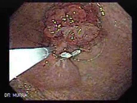 Multilobulated Gastric Polyp (10 of 20)