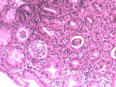 Ulcerative Colitis with Pseudopolyps (22 of 22)