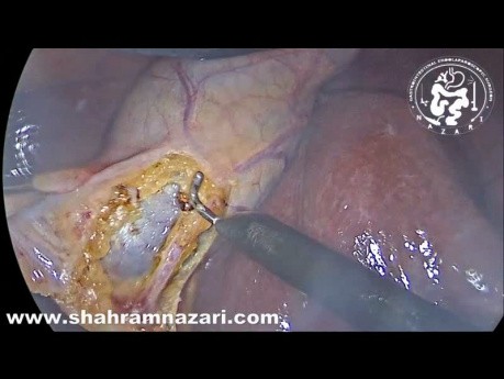 Finding Critical View of Safety in Laparoscopic Cholecystectomy