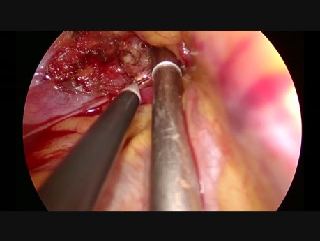 Uniportal VATS Resection of Apical Neurogenic Tumor at Thoracic Inlet
