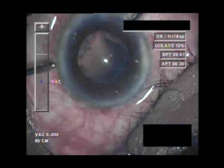 Cataract Surgery XI - Part 3