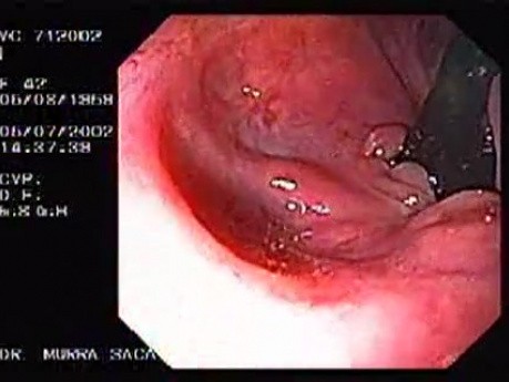 Crohn's Disease - Endoscopy (27 of 28)