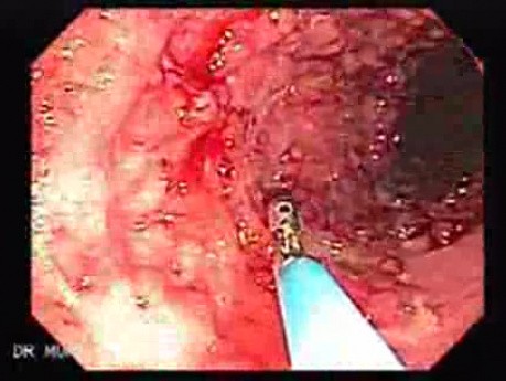 Colitis Ulcerosa - Pseudopolyps (15 of 22)