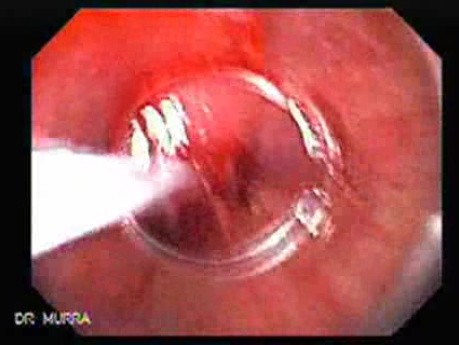 Mucosectomy as a Treatment for Early Gastric Cancer, Part 2
