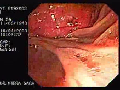 Adenocarcinoma of Papilla of Vater (3 of 4)