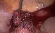 Laparoscopic suturing of rectal prolapse