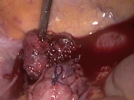 Laparoscopic suturing of rectal prolapse