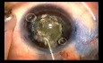 Capsulotomy in a small eye with use of Fugo Blade 