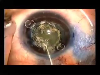 Capsulotomy in a small eye with use of Fugo Blade 