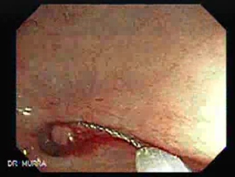 Polyp Inside Of A Diverticulum (8 of 12)