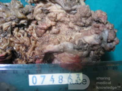 Synchronous Cancers, Familial Adenomatous Polyposis (29 of 36)