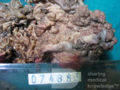 Synchronous Cancers, Familial Adenomatous Polyposis (29 of 36)
