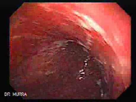 Gastroesophagic Varices - 66 - Year - Old Man (3 of 7) 