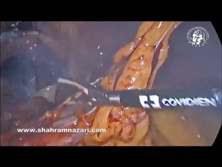 Intrathoracic Stomach in Paraesophageal Hiatal Hernia; The role of Laparoscopic Collis Gastroplasty