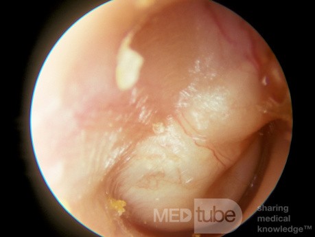 Large Congenial Cholesteatoma