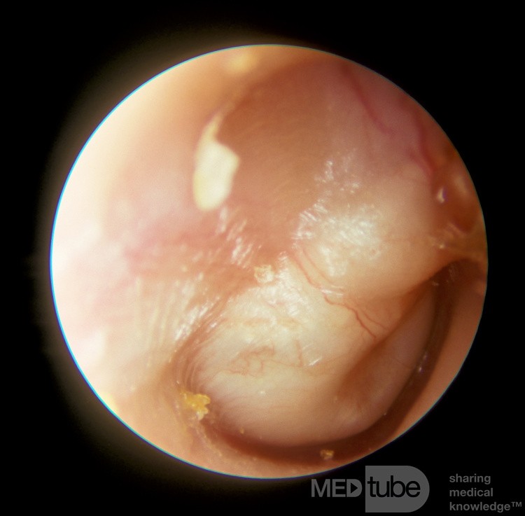 Large Congenial Cholesteatoma