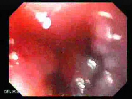 Ablative Therapy with Argon Plasma Coagulator - Status After Treatment