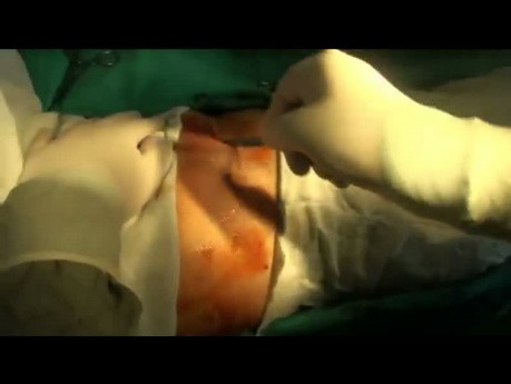 Ivor Lewis procedure. Esophagectomy for cancer with 2F (two field) lymphadenectomy