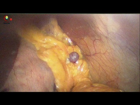 Splenule