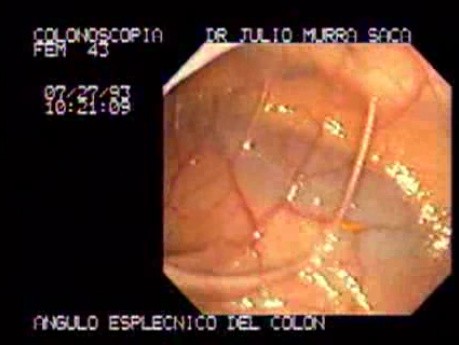 Splenic Flexure (2 of 2)
