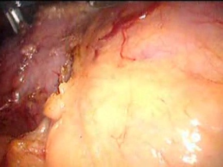 Gastrointestinal Stromal Tumor - GIST (25 of 65)