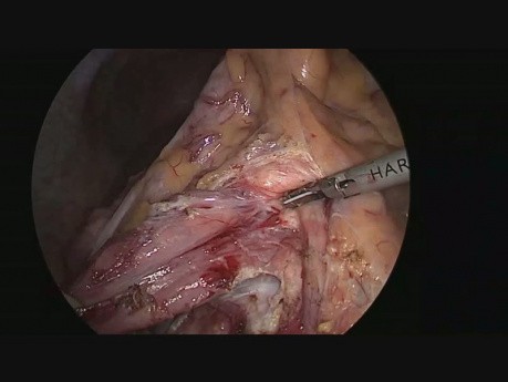 Laparoscopic Duodenojejunostomy For Superior Mesenteric Artery Syndrome