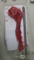 Incomplete Jejunoileal Junction Atresia Chronic Midgut Volvulus