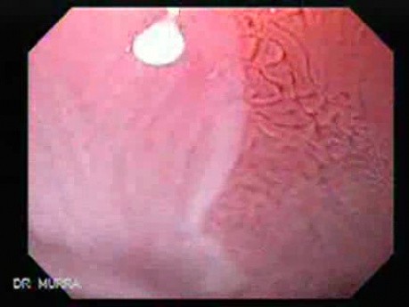 Endoscopic view of Barrett Esophagus -enchanced magnifying endoscopy - (3 of 9)