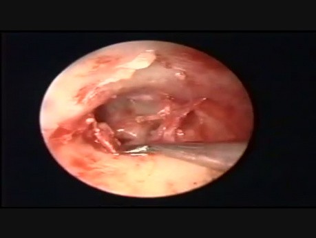 Endoscopic Myringoplasty