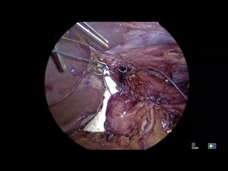 Geometry Fundoplication App Tutorial, Chapter 10 - Creation of a 270º Fundoplication