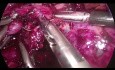 Laparoscopic Spleen Preserving Distal Pancreatectomy for MCN