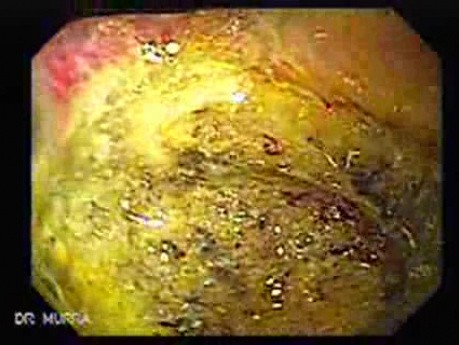 Klatskin´s Tumor - 75 Years-Old Female