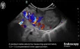 EUS-guided Ethanol Ablation for Mediastinal Parathyroid Adenoma Complicated by Nerve Injury