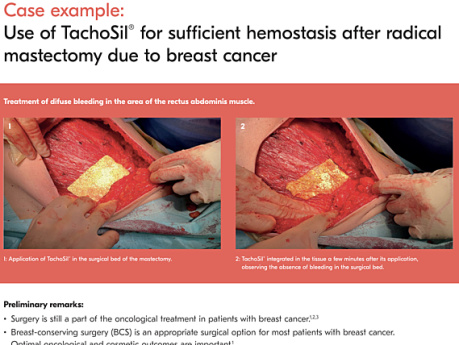 Use of TachoSil® for Sufficient Haemostasis After Radical Mastectomy Due to Breast Cancer