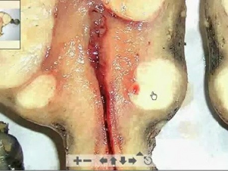 Kale's Myomas