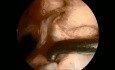 ACL All Inside and Meniscal Repair