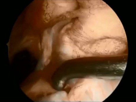 ACL All Inside and Meniscal Repair