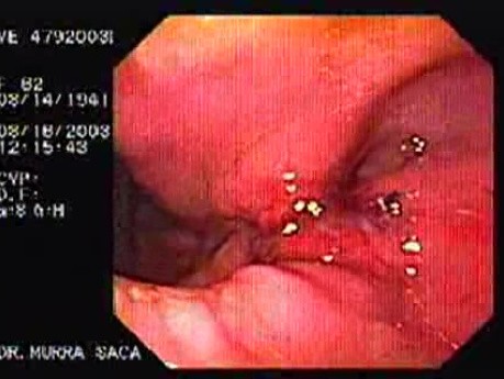 Intraluminal Endoscopic Suturing - Assessment of the First Gastroplicature, Part 2