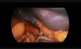 Laparoscopic Splenectomy in Child - "Vessels First" Technique