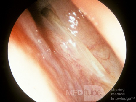 Sphenoid Sinusitis