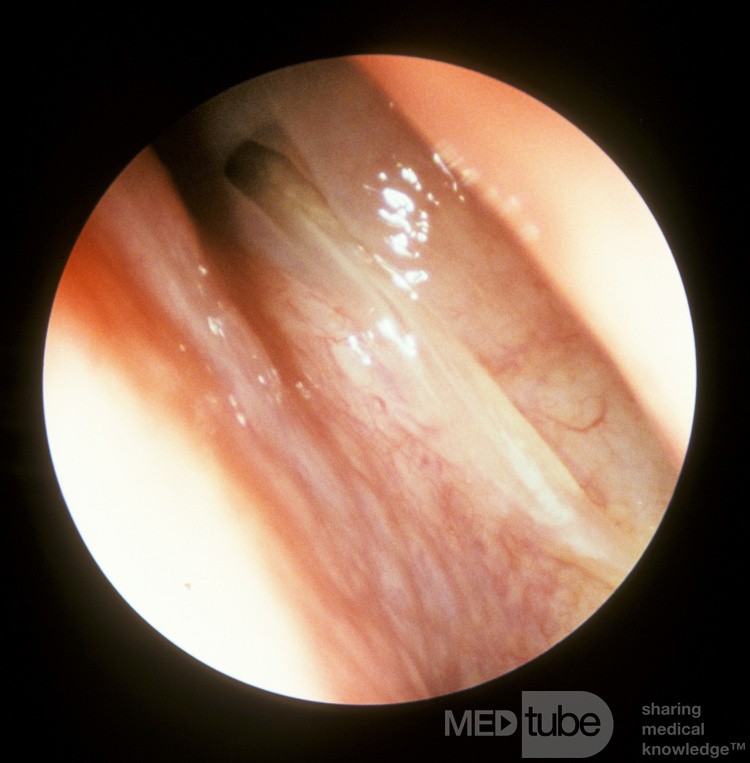 Sphenoid Sinusitis