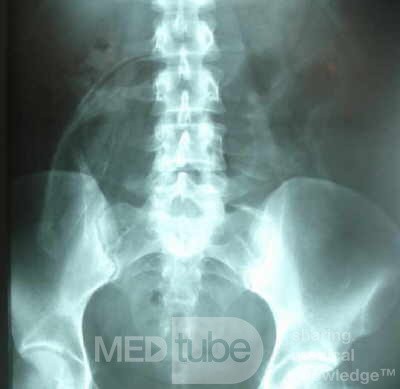 Intragastric Balloon Migration