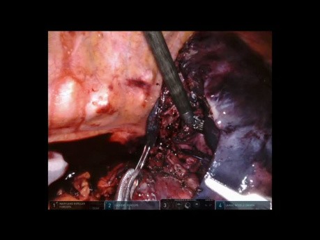 Right Lower Lobectomy with Bronchoplasty