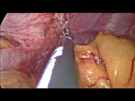 Laparoscopic Sleeve Gastrectomy