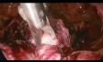 Cervical Ectopic Pregnancy Managed by Laproscopic Surgery
